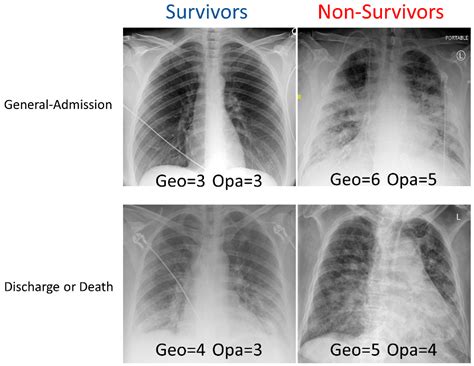 validity of chest x ray result|Development and prospective validation of COVID.